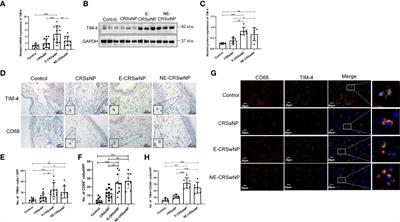 TIM-4 in macrophages contributes to nasal polyp formation through the TGF-β1–mediated epithelial to mesenchymal transition in nasal epithelial cells